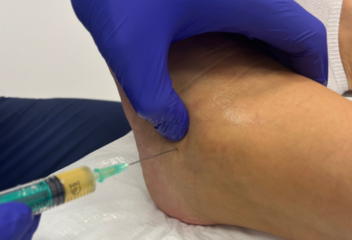 osocze bogatopłytkowe osocze bogatopłytkowe