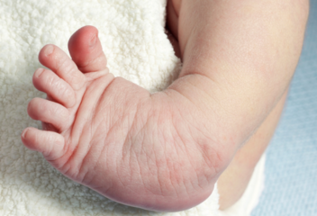 stopa końsko-szpotawa